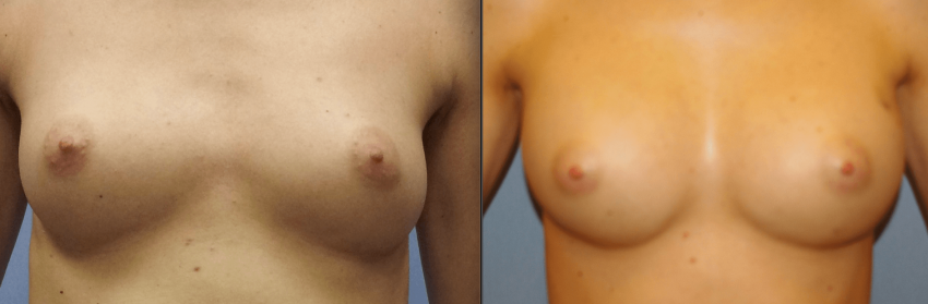 Powiększanie piersi własnym tłuszczem przed i po
