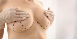 Podniesienie piersi – nici Aptos czy chirurgia? Co wybrać?